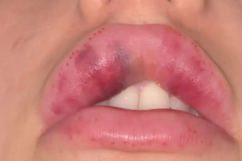 Lở loét, chảy máu tại vị trí tiêm filler