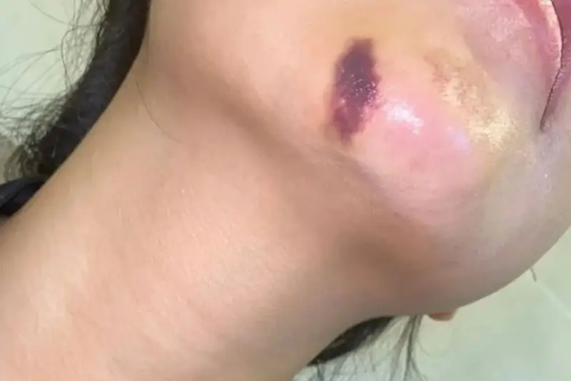 Thay đổi màu da ở vùng tiêm filler