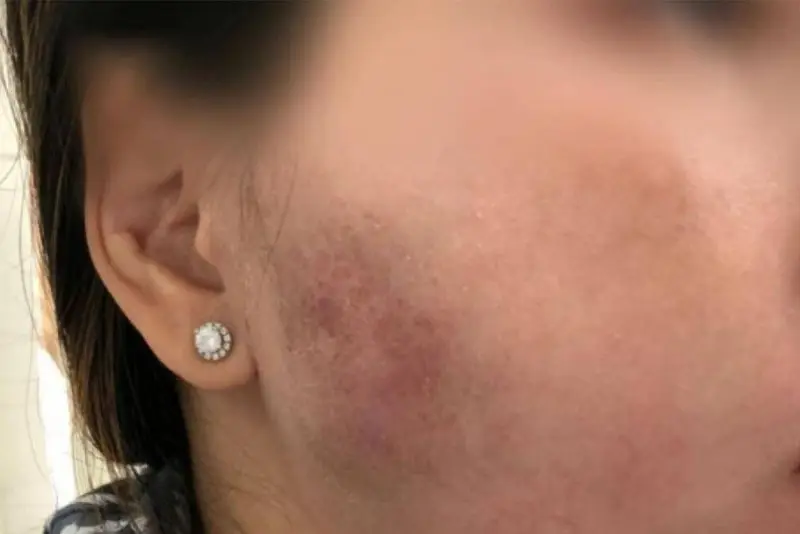 Vùng tiêm filler bị lồi lõm