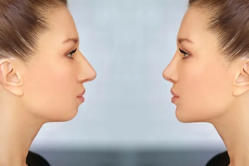 Độn cằm có thể duy trì kết quả lâu dài và ổn định