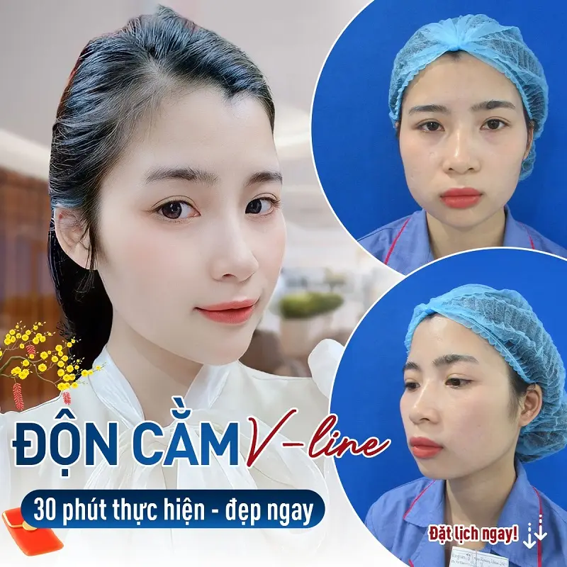 Độn cằm vline giúp khách hàng sở hữu dáng cằm đầy đặn, cân đối