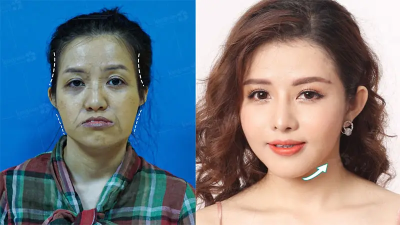 Khách hàng sở hữu khuôn mặt cân đối, thái dương đầy đặn