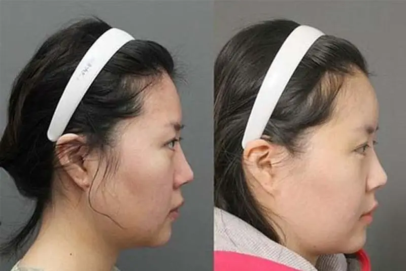 Chi phí độn trán tùy thuộc vào vật liệu độn, bác sĩ và cơ sở thực hiện