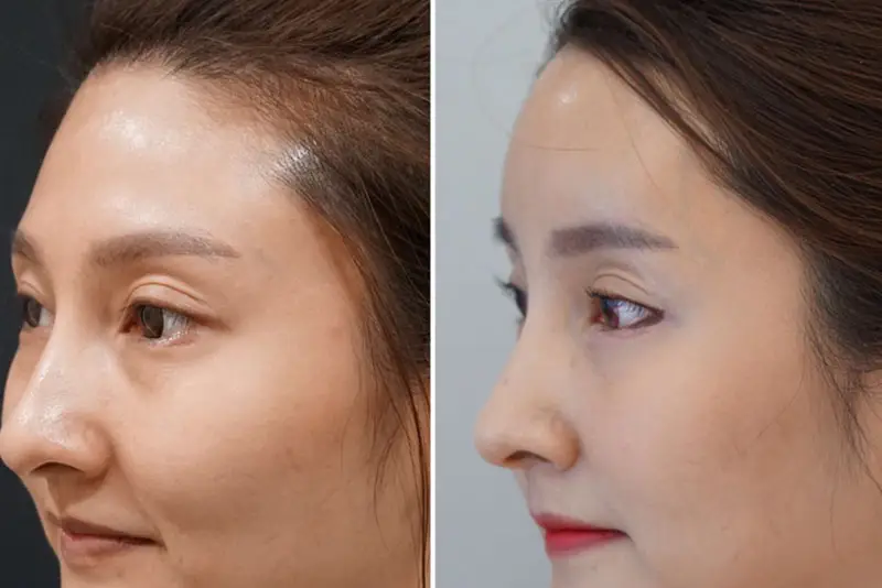 Phẫu thuật độn trán