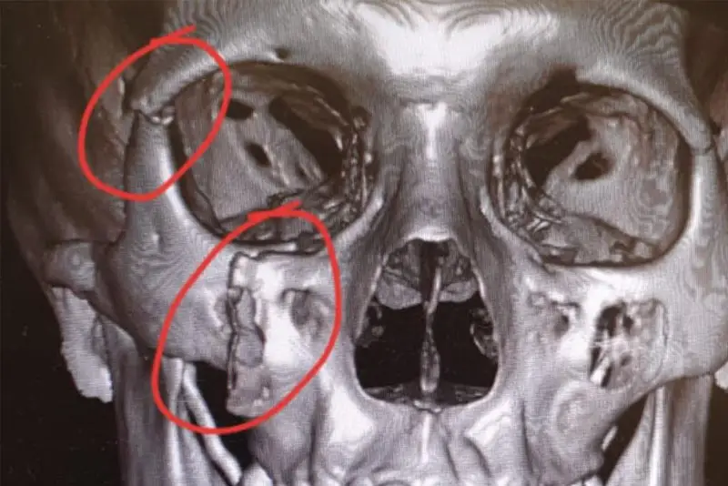 Vỡ xương gò má gây di lệch nhiều