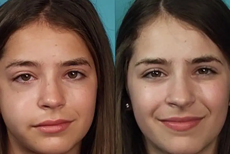 Hồi phục sau gãy xương gò má