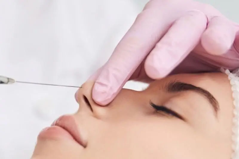 Giá nâng mũi chỉ khác nhau tùy vào loại chỉ sử dụng