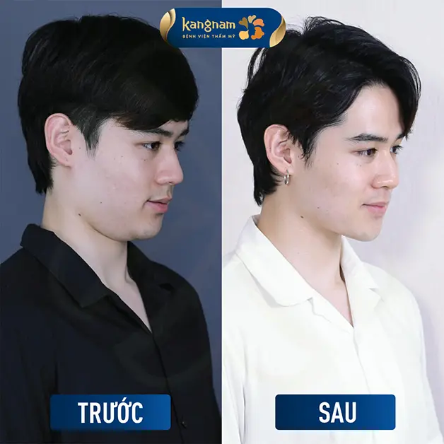 Nên thăm khám trực tiếp để biết chính xác mức giá hút mỡ