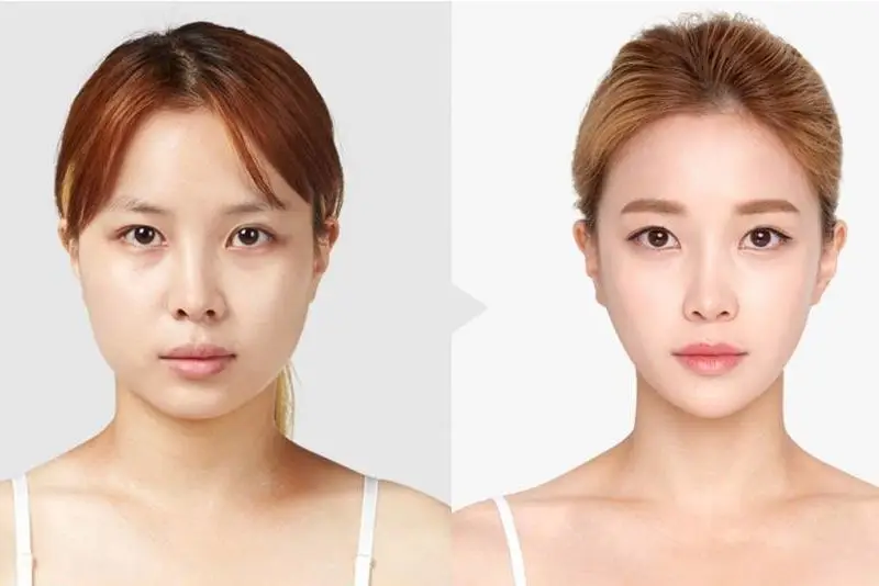 Chi phí gọt cằm phụ thuộc nhiều yếu tố