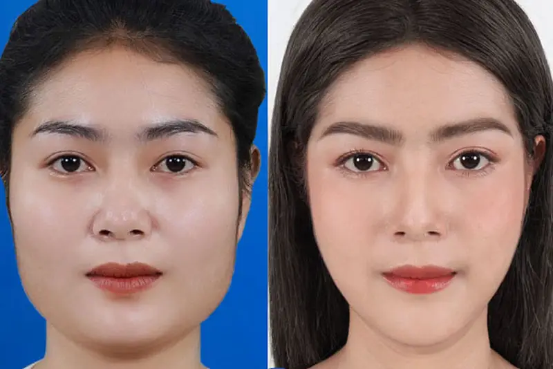 Gọt hàm nếu thực hiện đúng quy trình kỹ thuật sẽ không ảnh hưởng