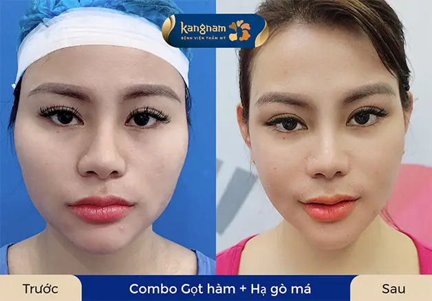 Khách hàng gọt hàm kết hợp hạ gò má
