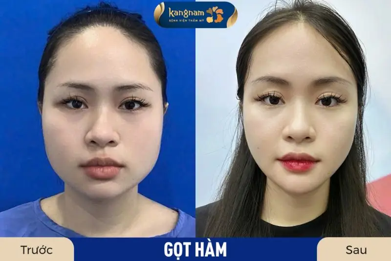 Gọt hàm không nguy hiểm khi thực hiện tại cơ sở uy tín