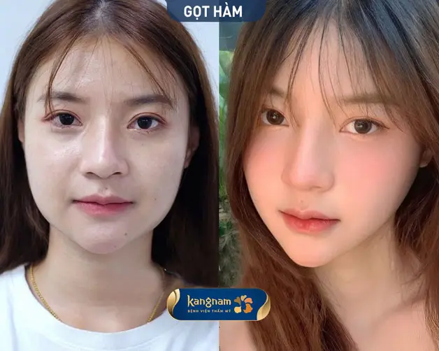 Gương mặt cân đối sau khi gọt hàm