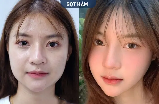 gọt hàm giúp cải thiện góc cạnh, tạo sự cân đối và mềm mại hơn cho khuôn mặt