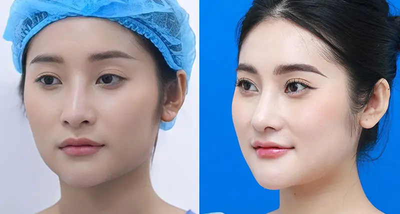 Khách hàng sở hữu khuôn mặt cân đối, thon gọn sau khi gọt hàm