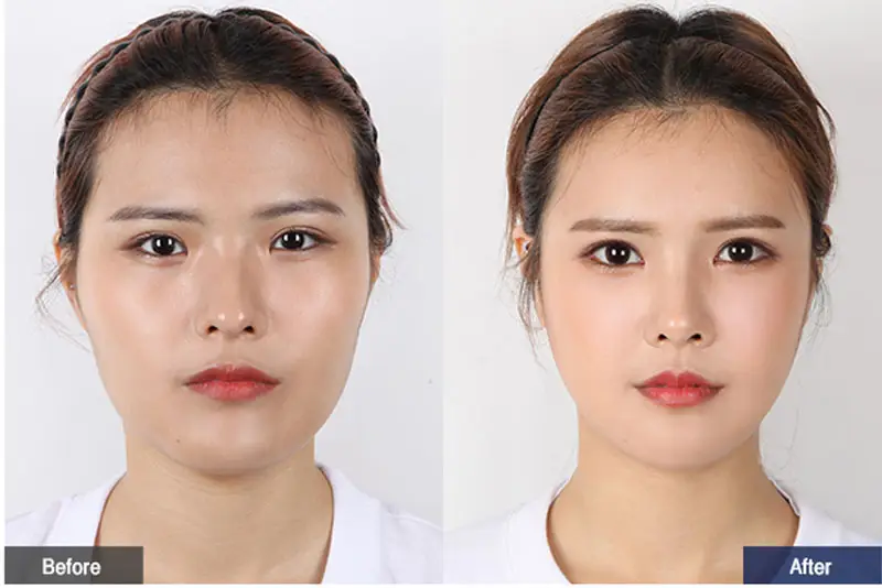 Hạ gò má tại địa chỉ uy tín thường cao hơn nhưng bù lại có kết quả đẹp