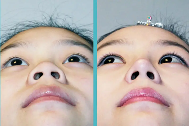 Cắt cánh mũi sau 1 tháng, chóp mũi cao, cánh mũi thon gọn hơn