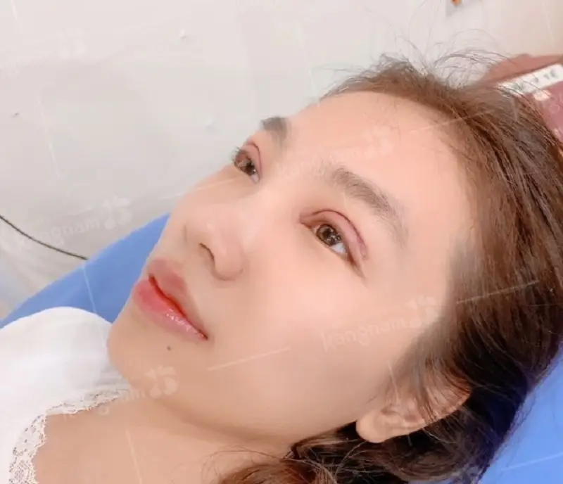 Mí mắt sau 3 ngày đã lành miệng 