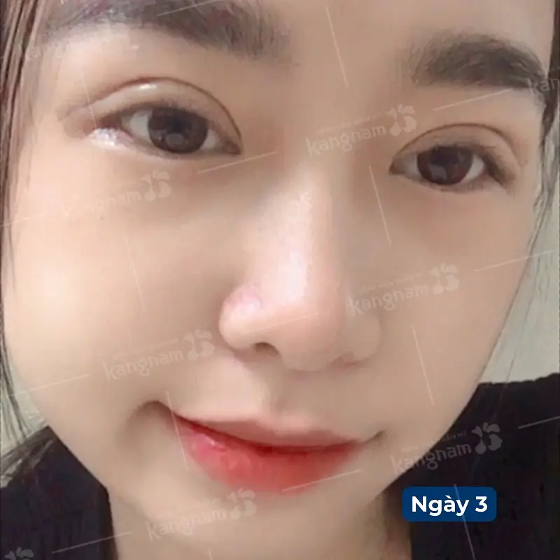 Vết thương cắt mí mắt sau 3 ngày vẫn còn hơi sưng