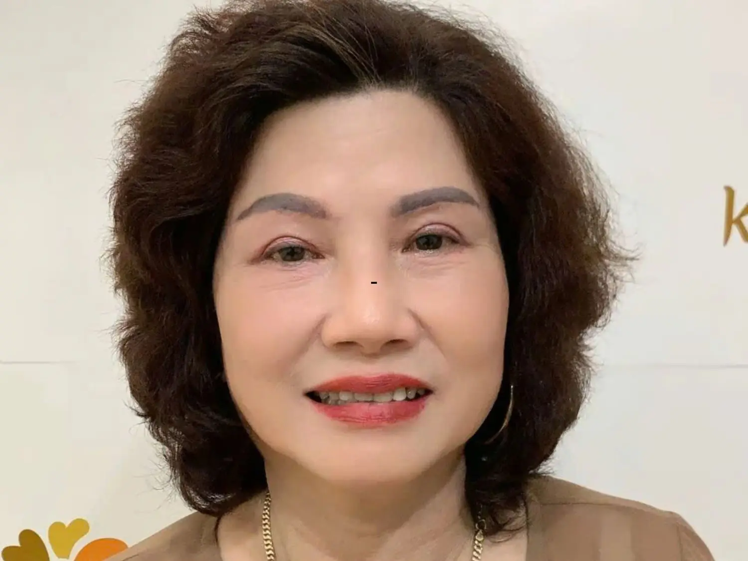 Hình ảnh trước và sau cắt mí dưới 7 ngày với vùng bọng mắt giảm rõ, gương mặt tươi trẻ và đều mí hơn.