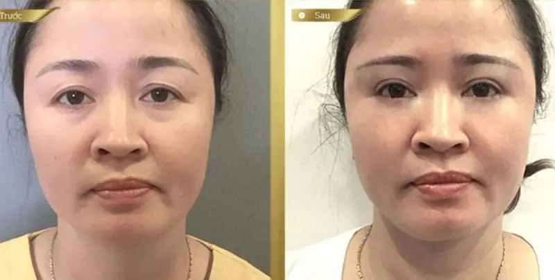 Sau 1 tháng vùng mắt dưới đã rõ nét, tươi trẻ hơn