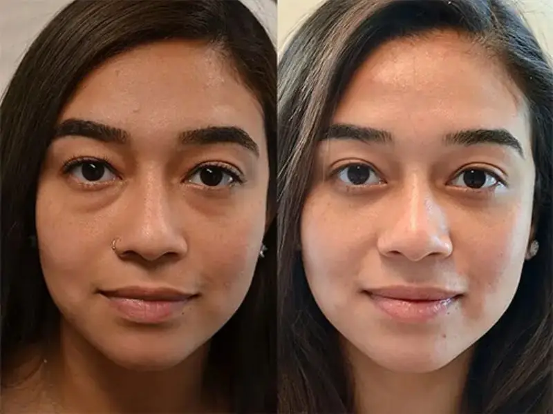 Sau cắt mí dưới khách hàng sở hữu đôi mắt đầy sức sống, trẻ trung hơn