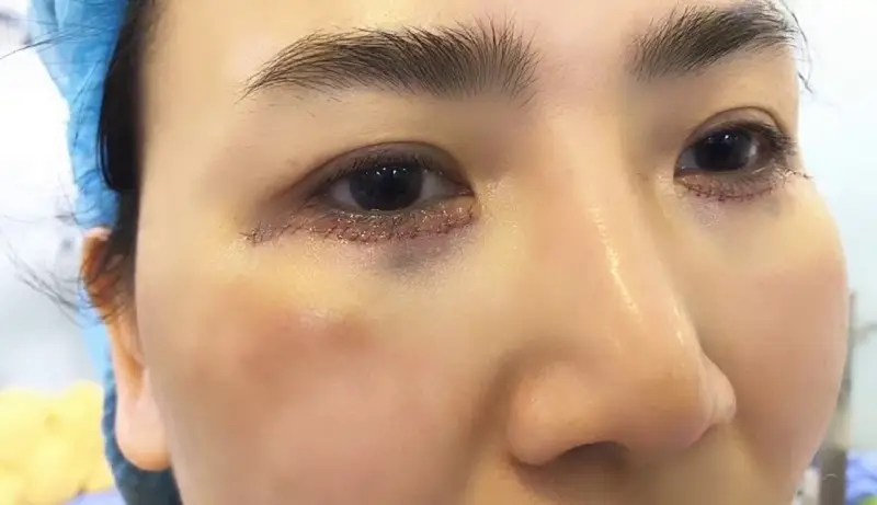 Mí mắt dưới gặp tình trạng sưng tấy những ngày đầu sau cắt mí