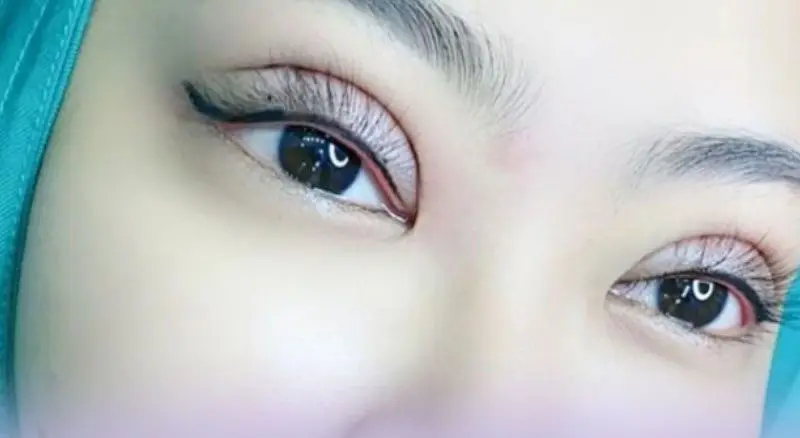 Hình ảnh cắt mí sau 3 ngày vết thương đang trong quá trình phục hồi