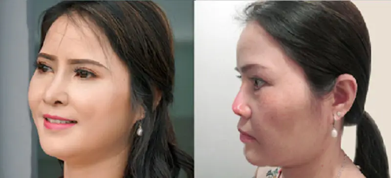 Hình ảnh nâng mũi khi lớn tuổi, mũi thấp dần