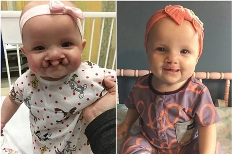 Hình ảnh sau khi phẫu thuật hở hàm ếch ở trẻ nhỏ