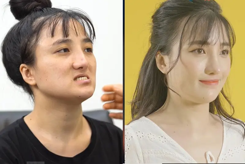 Hình ảnh trước và sau khi phẫu thuật hở hàm ếch của Nguyễn Thị Huyền