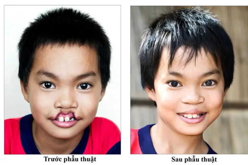 Hình ảnh sau khi phẫu thuật hở hàm ếch ở thanh thiếu niên