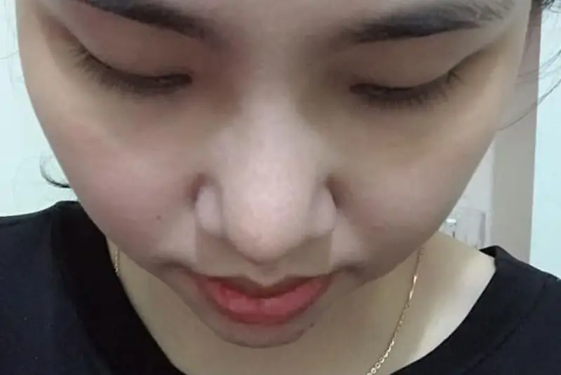 Hình ảnh sau khi tháo sụn mũi, mũi trở về hình dáng gần như ban đầu