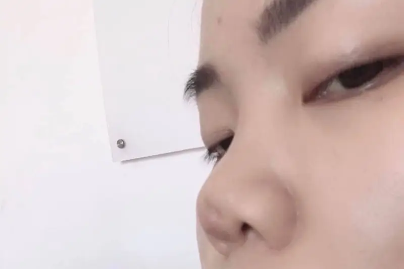 hình ảnh sau khi tháo sụn mũi do biến dạng khiến đầu mũi bị lõm