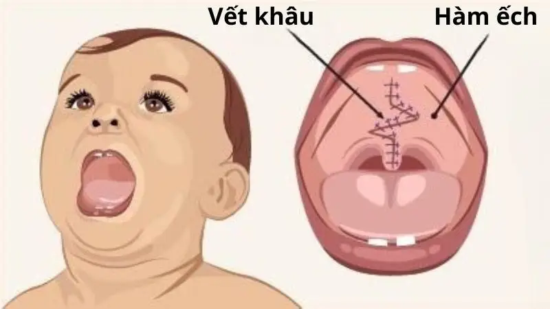 Phẫu thuật hở hàm ếch giúp đóng kín khe hở giữa mũi và miệng
