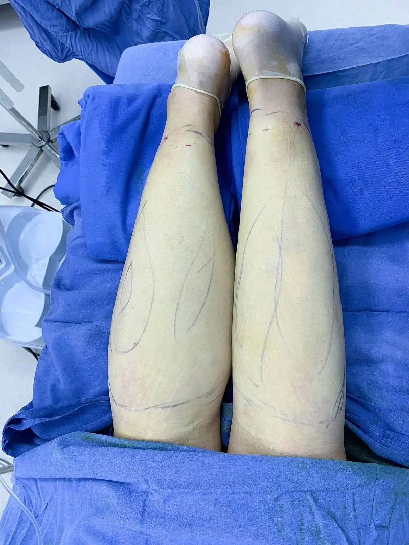 Hút mỡ bắp chân giúp loại bỏ mỡ thừa hiệu quả