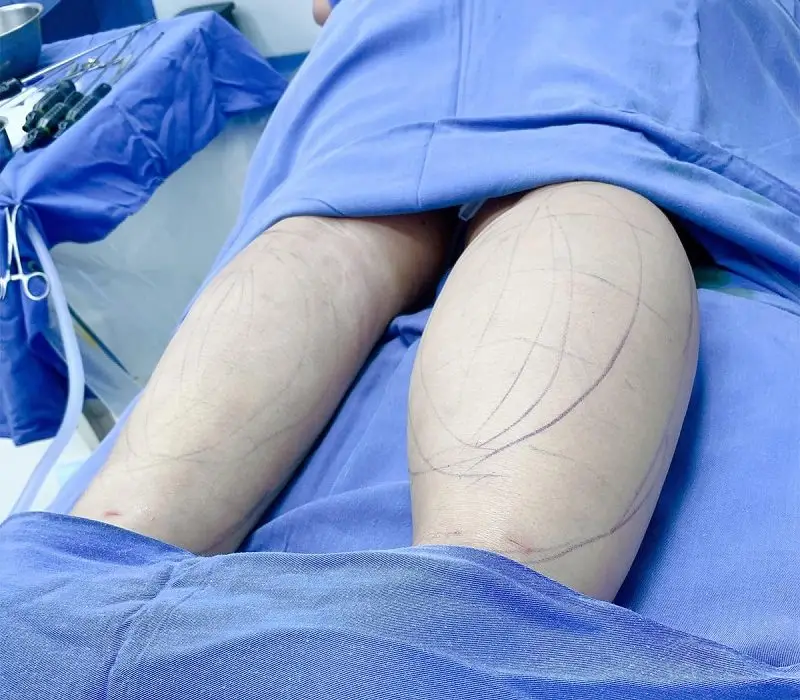 Sau khi hút mỡ bắp chân khách hàng sẽ sở hữu đôi chân thon gọn hơn