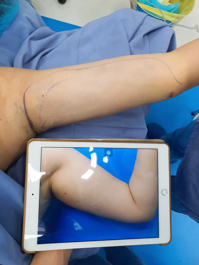 Cánh tay thon gọn, săn chắc sau hút mỡ