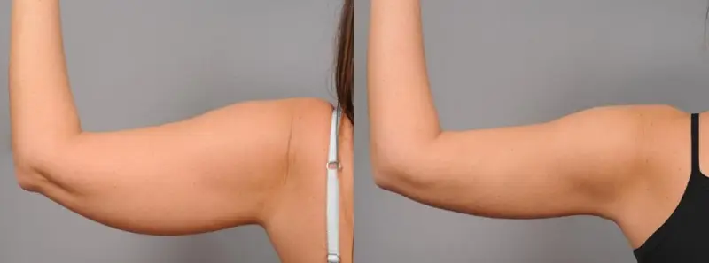 Chi phí hút mỡ bắp tay trên thị trường rất đa dạng