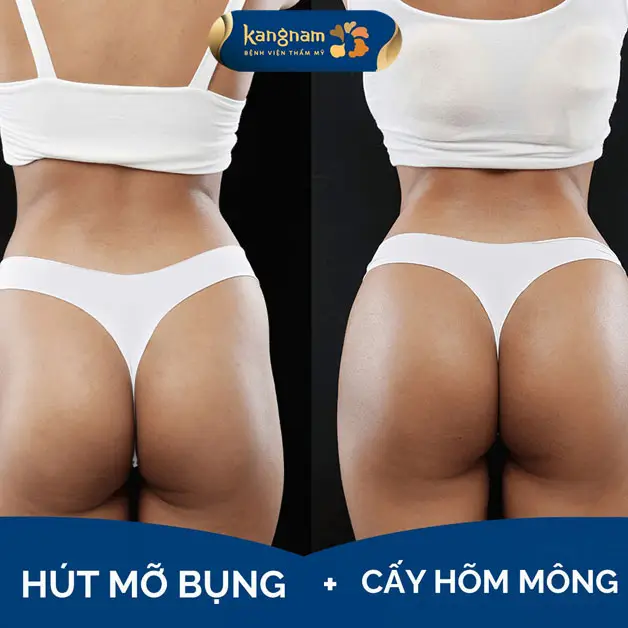 Cấy mỡ hõm mông giúp thân hình cân đối và đẹp hơn