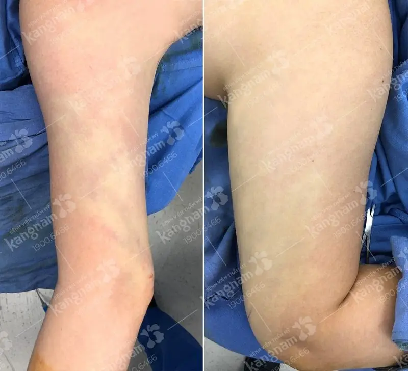 Hút mỡ cánh tay tại địa chỉ thẩm mỹ uy tín giúp khách hàng có được kết quả như ý