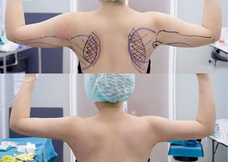 Hút mỡ bằng phương pháp hiện đại giúp loại bỏ mỡ thừa vùng lưng nách nhanh chóng, không gây tổn thương