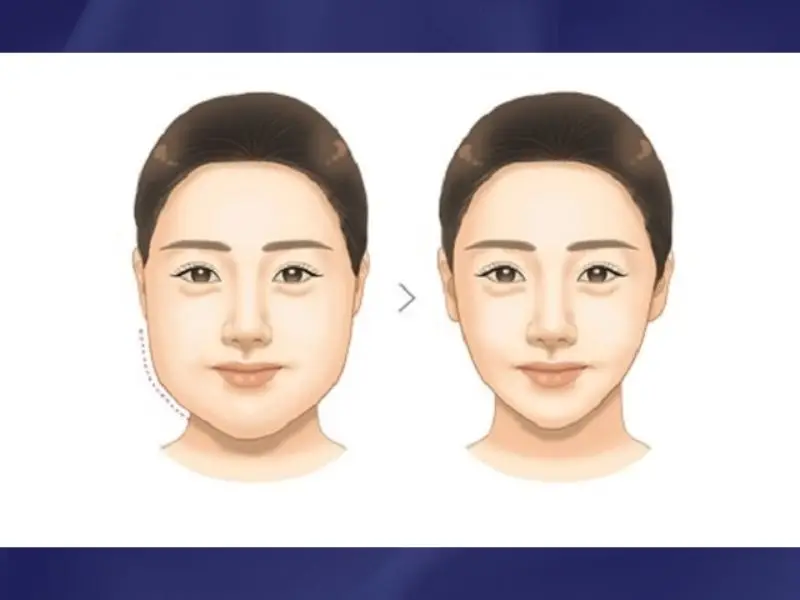 Hút Mỡ Má - Phương Pháp Mang Lại Gương Mặt Thon Gọn, Hoàn Mỹ