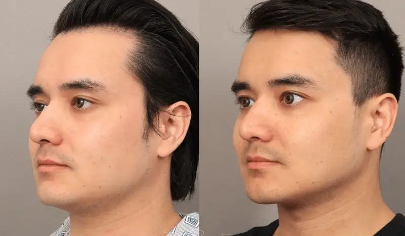 Chi phí hút mỡ mặt trên thị trường rất đa dạng