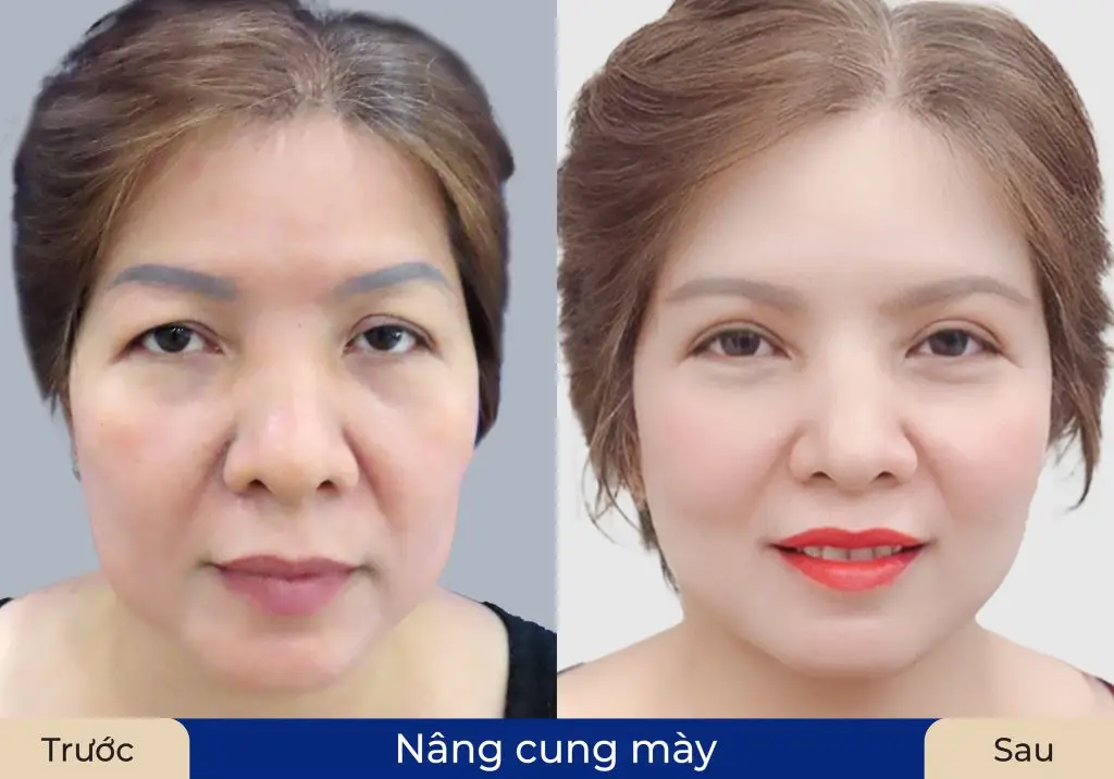 Kết nâng cung mày đẹp tự nhiên, cân đối khi khách hàng thực hiện tại địa chỉ thẩm mỹ uy tín