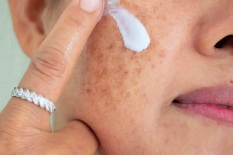 Kem trị tàn nhang thường chứa vitamin C, arbutin hoặc axit kojic