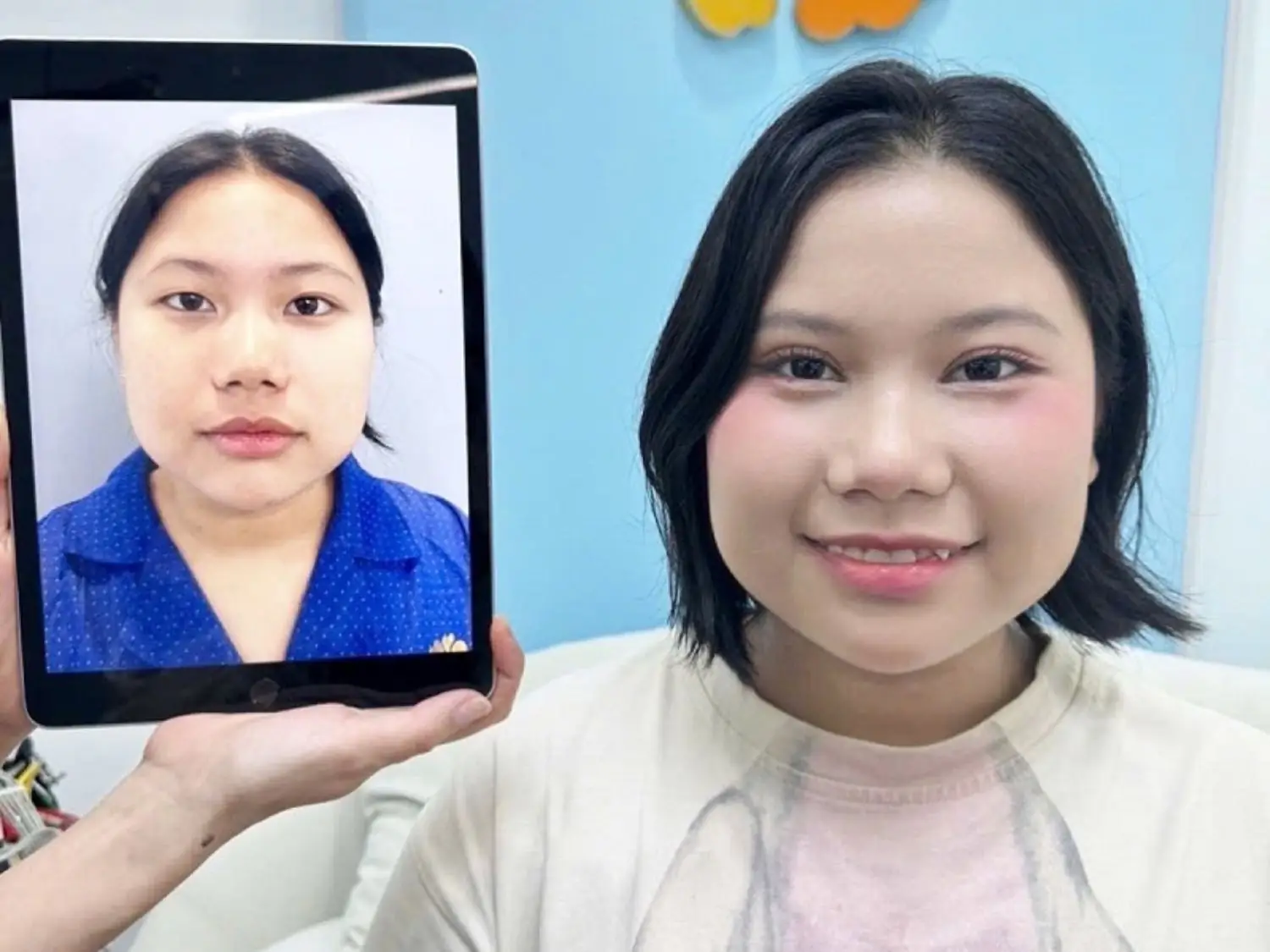 Sự thay đổi ngoạn mục của khách hàng Thúy Hằng: Khắc phục hoàn toàn tình trạng mí lót, lệch; nếp mí mới cân đối và tự nhiên sau 7 ngày.