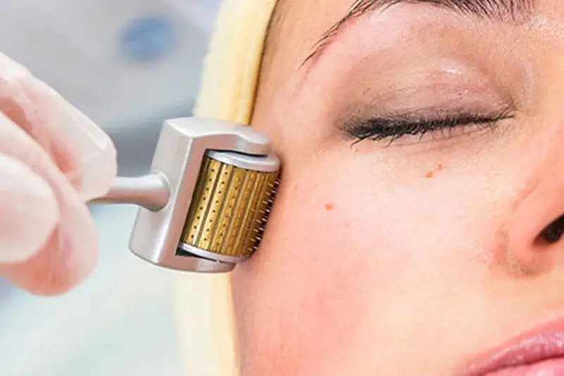 Lăn kim là phương pháp trị tàn nhang hiệu quả