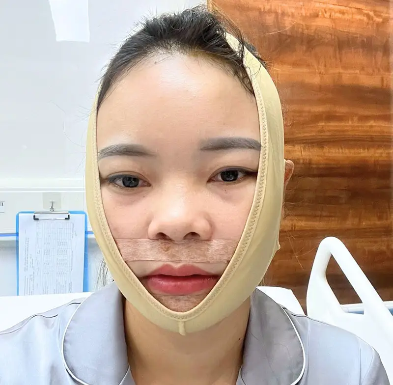 Mới phẫu thuật gọt hàm sẽ có hiện tượng sưng