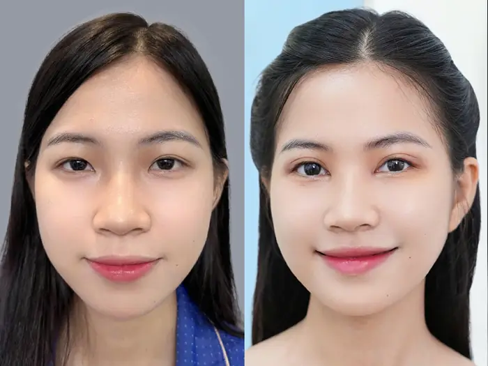 Hình ảnh mô phỏng sự thay đổi của nếp mí: Từ giai đoạn sưng bầm (ngày 1-3) đến khi nếp mí gom lại (tháng 1) và đạt độ tự nhiên hoàn toàn (tháng 6).